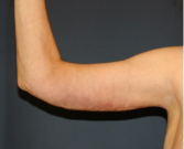 Feel Beautiful - Arm Reduction 208 - After Photo
